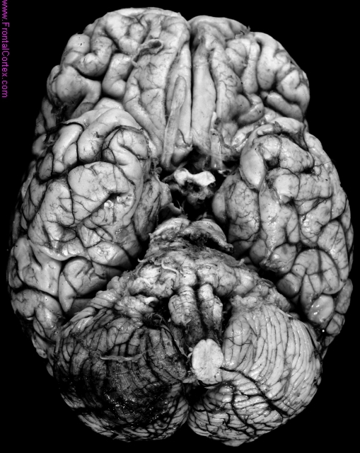 Right posterior inferior cerebellar artery infarct